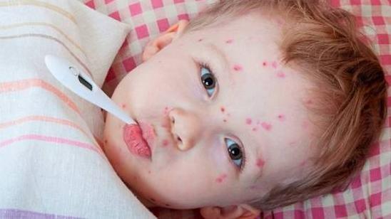 Стаття Эпидемия кори в Одессе: как будут учиться дети без прививок? Ранкове місто. Одеса